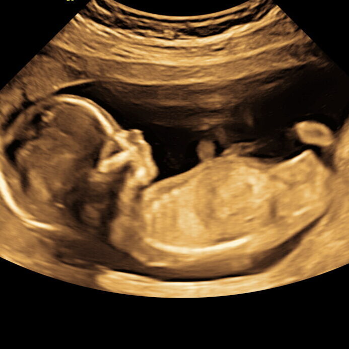 Misdannelsesscanning